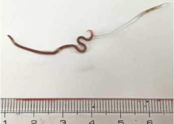 Disgusting! After Eating Sashimi, a Worm was Lodged in This Woman’s Throat