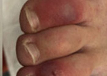 Scientists Have Said that People Infected With Coronavirus May End Up Developing a Skin Symptom