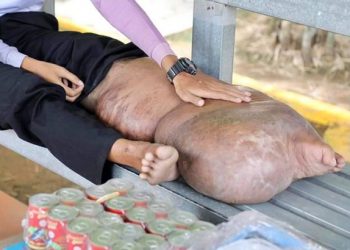 A Man Has Incurable Lymphatic Filariasis, After Infected Mosquito Bites Two Decades Ago