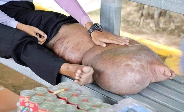 A Man Has Incurable Lymphatic Filariasis, After Infected Mosquito Bites Two Decades Ago