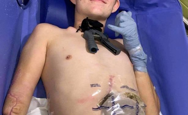 Tragic, a Teen Crushed by Forklift and Chooses to Have Half His Body Amputated