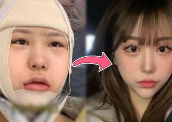 A Popular Korean YouTuber Sharing Her Liposuction Transformation