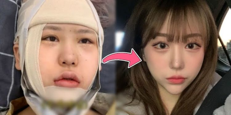 A Popular Korean YouTuber Sharing Her Liposuction Transformation
