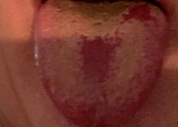 Covid Tongue, a New Symptom of Coronavirus Infection