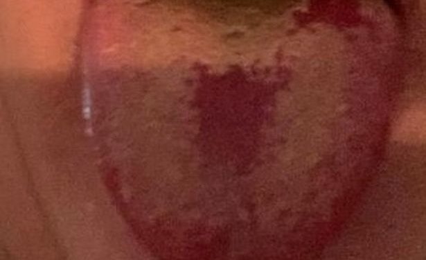 Covid Tongue, a New Symptom of Coronavirus Infection