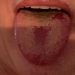 Covid Tongue, a New Symptom of Coronavirus Infection