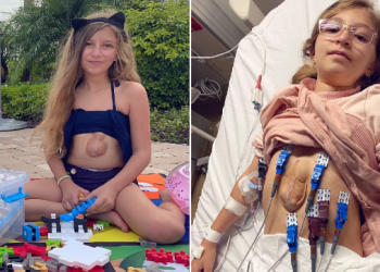 Amazing, a Girl that Born With a Heart that Beats Outside Her Chest Try To Live More Longer