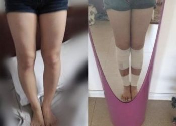 The Picture of Before And After from a Girl that Undergoes Leg Lengthening Surgery