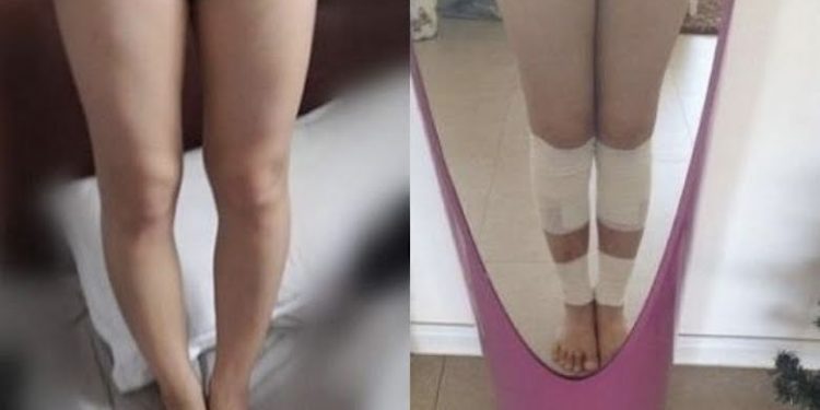 The Picture of Before And After from a Girl that Undergoes Leg Lengthening Surgery