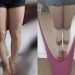 The Picture of Before And After from a Girl that Undergoes Leg Lengthening Surgery