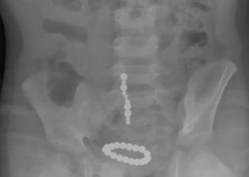 Horrifying, a Little Girl Swallowed Two Dangerous Magnet Toys, Can Burn Holes in Intestines