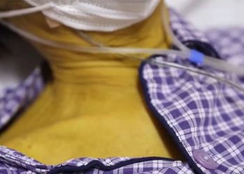 Viral, Horrendous Photographs Show Skin of Smoker has Turned Bright Yellow