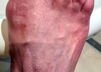 After Getting Long COVID, a Woman Left With Burns that Explodes from Inside