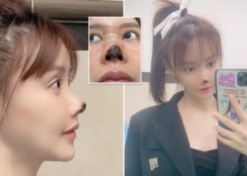 Be Careful, a Chinese Actress Shared Her Experiences About the Dangers of Cosmetic Surgery