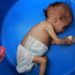 UN Said Half of the Yemeni Children Under 5, Face Acute Malnutrition