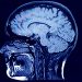 Scientists Have Identified a Serious Impact of Coronavirus on the Brain