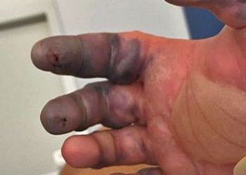 Seorang Turis Inggris Digigit Laba-laba Beracun di Ibiza, Terpaksa Diamputasi