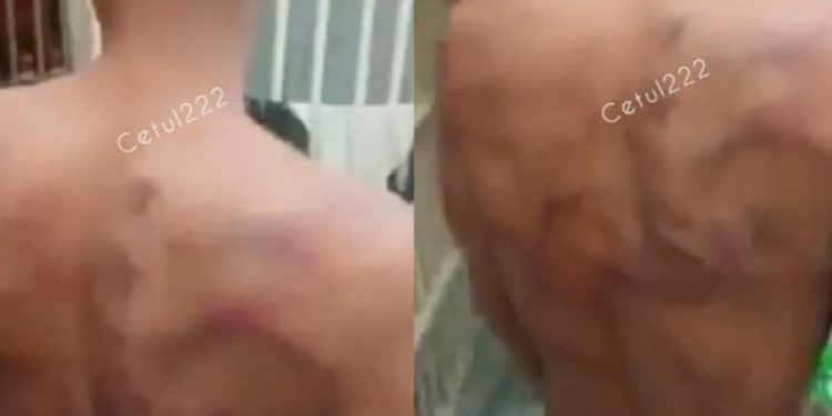 Narapidana Dipukul Pegawai Lapas Kelas 1 Medan Hingga Alami Luka Memar Jika Tak Beri Uang