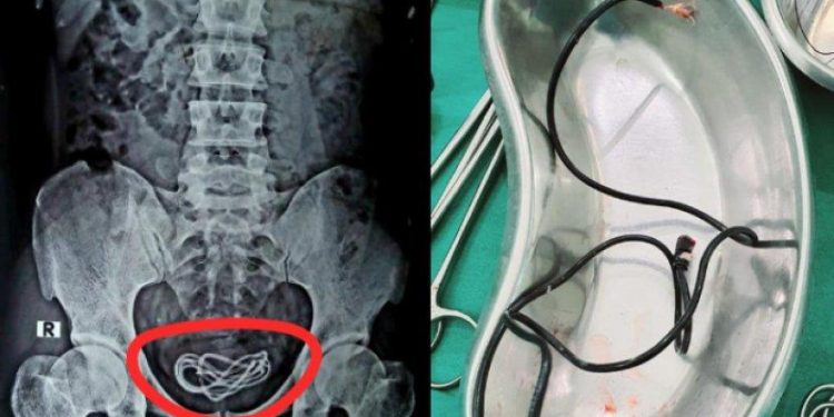 Penasaran dengan Panjang Penisnya, Remaja ini Masukkan Kabel USB ke Alat Kelamin Hingga Tersangkut