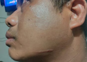 Seperti Ini Kondisi Anggota Polri Usai Adu Jotos dengan Oknum TNI di Ambon