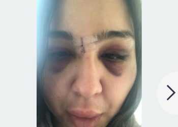 Wajah Memar hingga Hidung Patah, Wanita Ini Dihajar Pria yang Dikenalnya Lewat Aplikasi Kencan