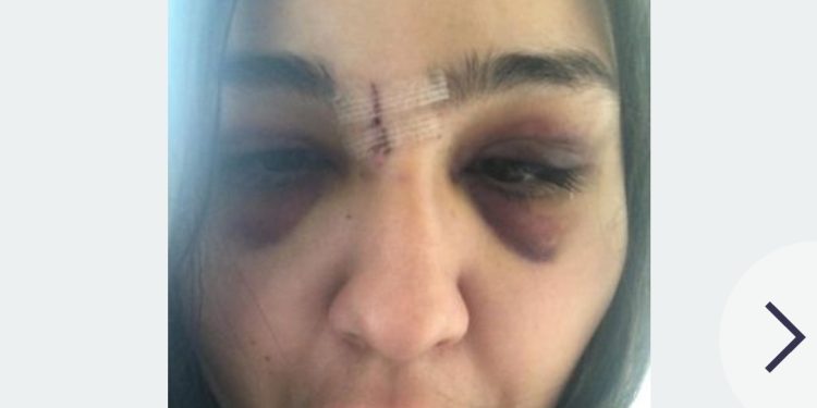 Wajah Memar hingga Hidung Patah, Wanita Ini Dihajar Pria yang Dikenalnya Lewat Aplikasi Kencan