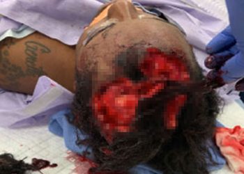 Kulit Kepalanya Habis Dirobek Anjing Polisi, Wanita Ini Ajukan Gugatan