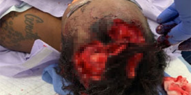 Kulit Kepalanya Habis Dirobek Anjing Polisi, Wanita Ini Ajukan Gugatan