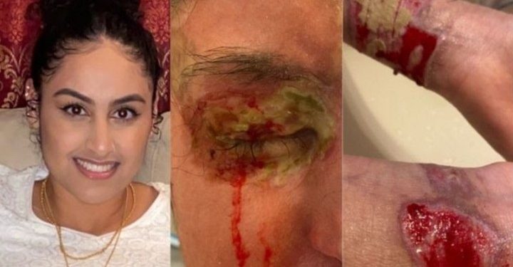 Mahasiswa Asal Pakistan Disirami Cairan Asam oleh Orang Asing, Sebabkan Kebutaan