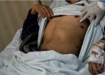 Hong Kong catat kasus pertama virus monkeypox