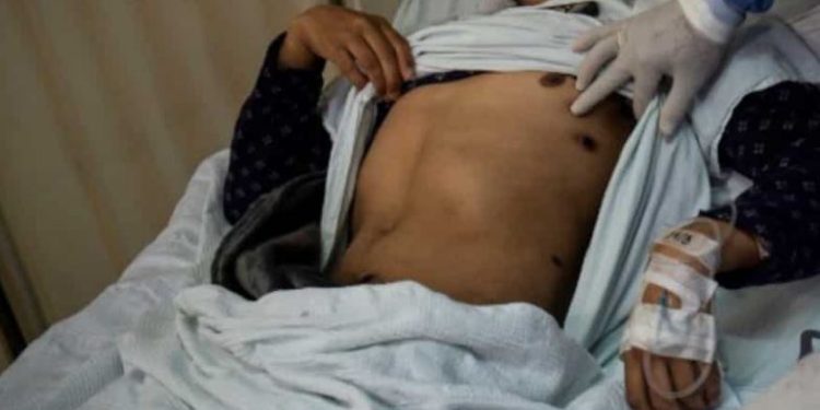 Hong Kong catat kasus pertama virus monkeypox