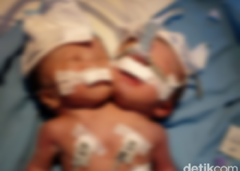 Kasihan, di Pariaman Lahir Bayi Kembar Siam Satu Badan Dua Kepala