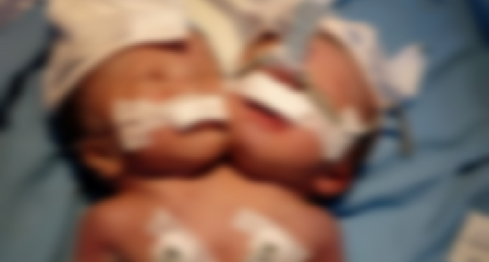 Kasihan, di Pariaman Lahir Bayi Kembar Siam Satu Badan Dua Kepala