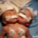 Kasihan, di Pariaman Lahir Bayi Kembar Siam Satu Badan Dua Kepala