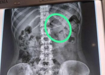 Hendak Pakai Jilbab Seorang Remaja di Playen Telan Jarum Pentul