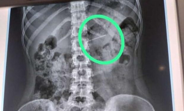 Hendak Pakai Jilbab Seorang Remaja di Playen Telan Jarum Pentul