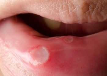 Dikira Sariawan Biasa, Wanita Inggris Jalani Operasi Pemotongan Lidah