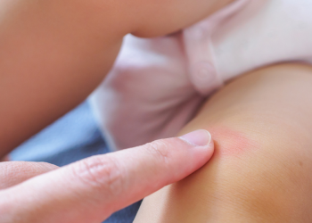 Cara Mengatasi Iritasi Pada Popok Bayi