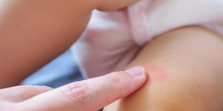 Cara Mengatasi Iritasi Pada Popok Bayi