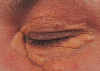 5 Gejala Kolesterol Terlihat Jelas di Kulit, Begini Bentuknya