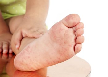 Cara Mengobati Kutu Air Dengan Bahan Alami