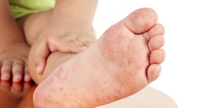 Cara Mengobati Kutu Air Dengan Bahan Alami