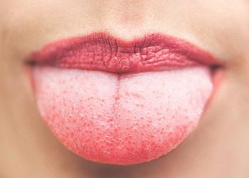 Warna Lidah Tertentu Jadi Gejala Kolesterol Tinggi