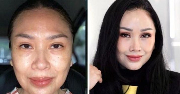 Mau Operasi Anti Aging seperti Titi DJ? Siapin Duit Segini