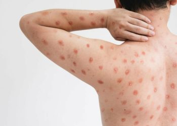 Waspada dan Kenali Cara Penularan Cacar Monyet!