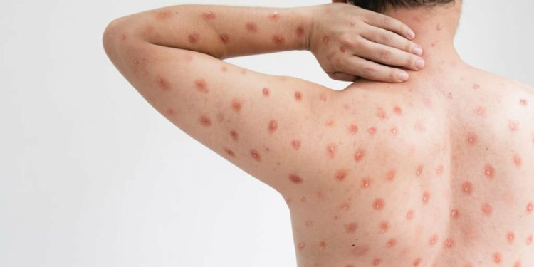 Waspada dan Kenali Cara Penularan Cacar Monyet!